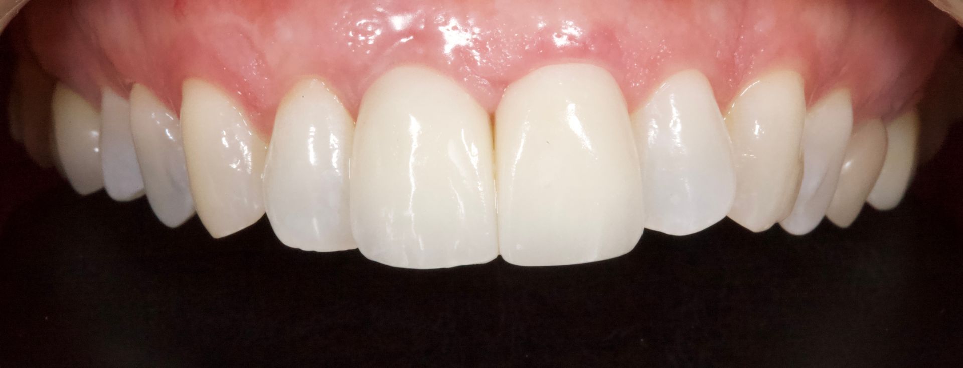 Close-up of a smiling mouth with white teeth and pink gums