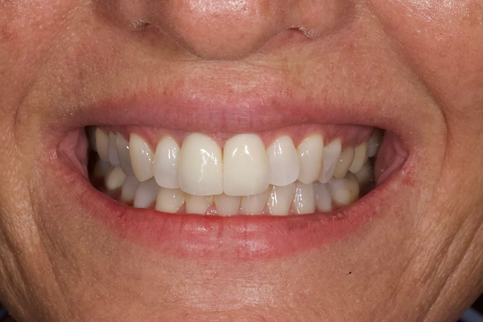 Close-up of a smiling mouth showing straight white teeth
