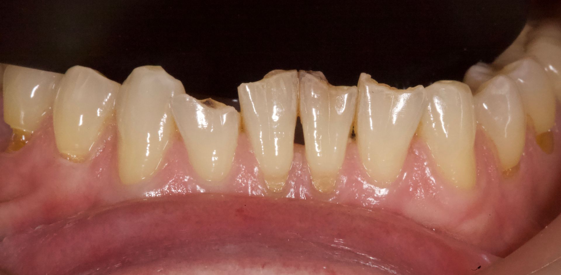 Close-up of lower front teeth with noticeable gaps and slight crowding, against the pink gums