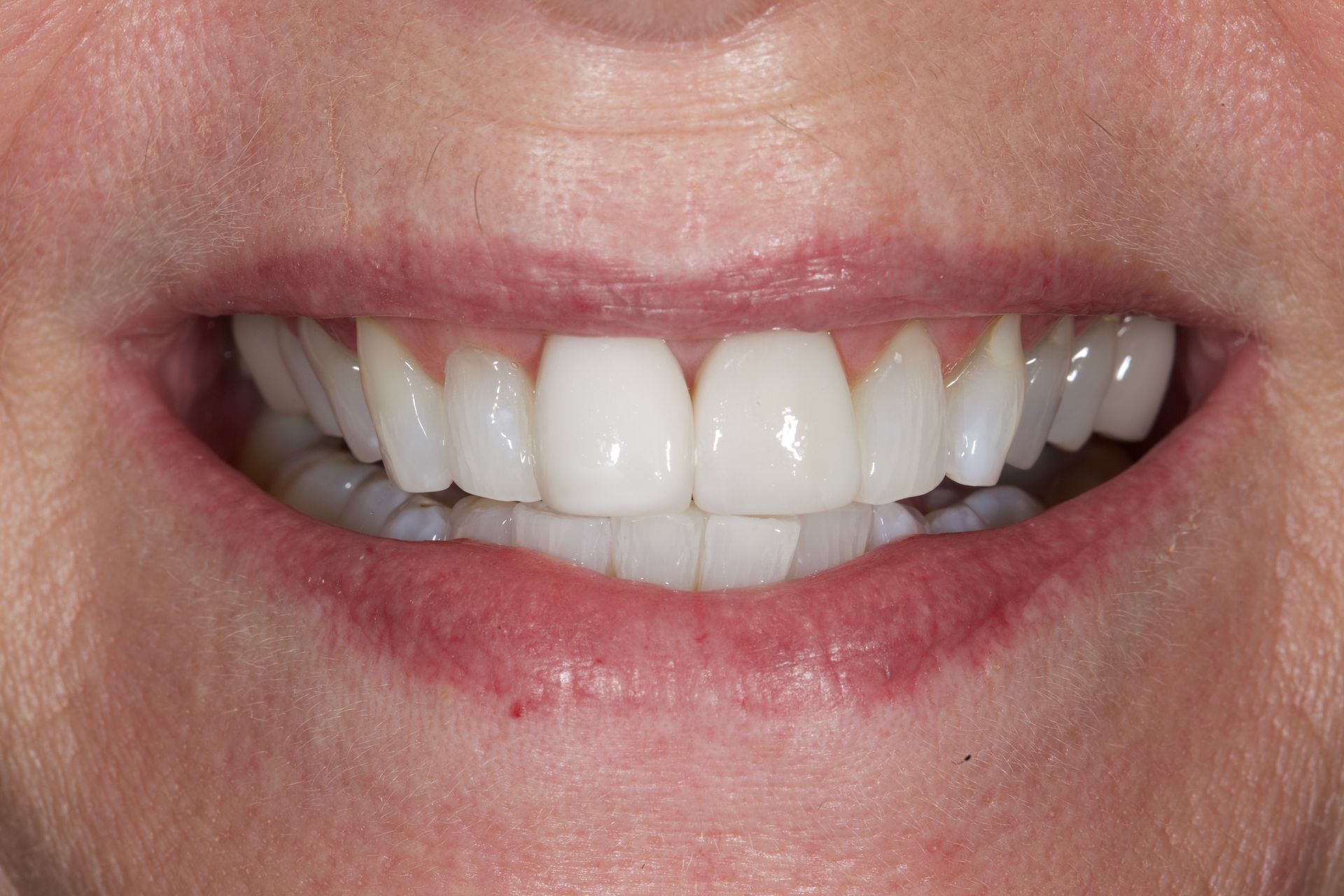 Close-up of a smiling mouth showing white teeth and pink lips