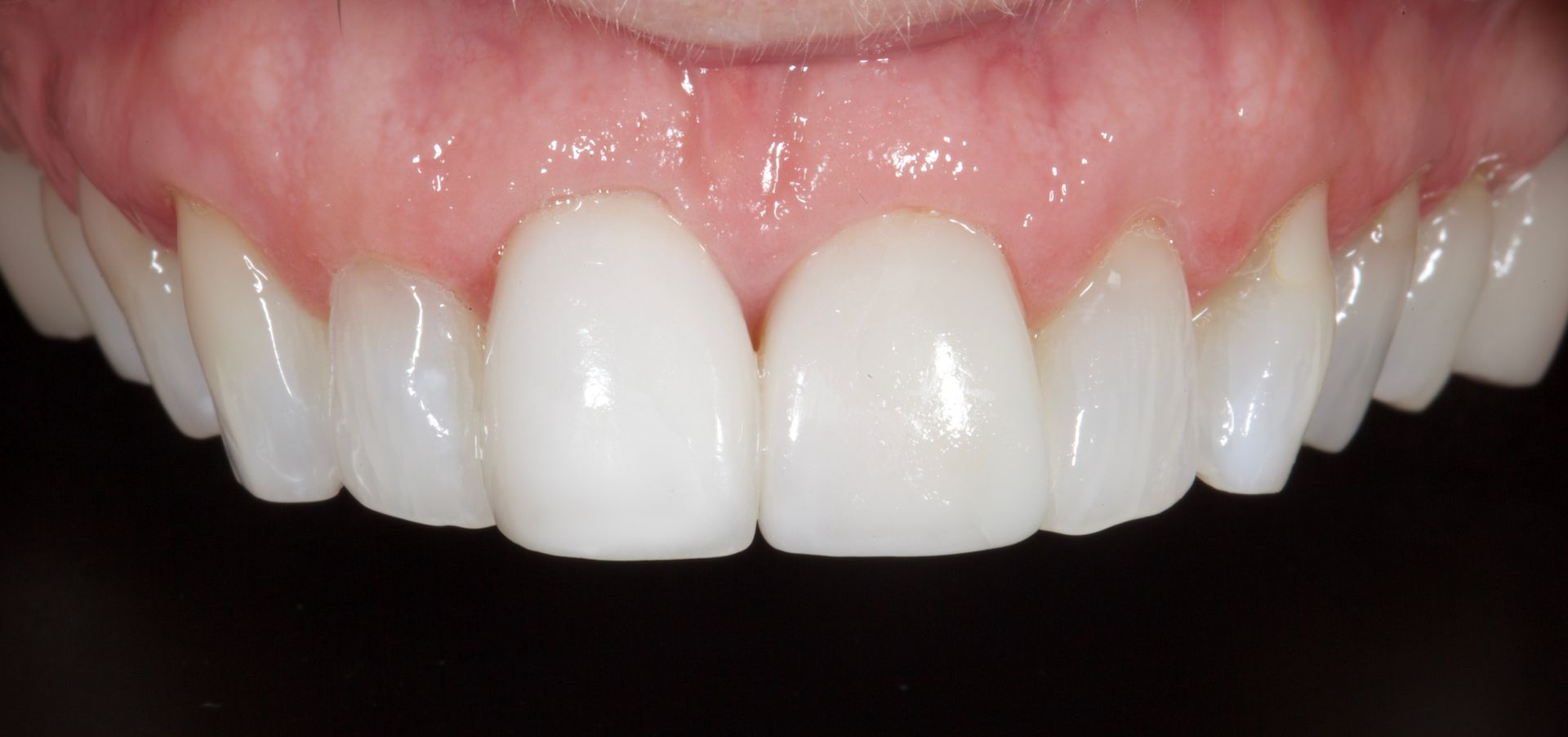 Close-up of bright white upper teeth and pink gums in a smiling mouth