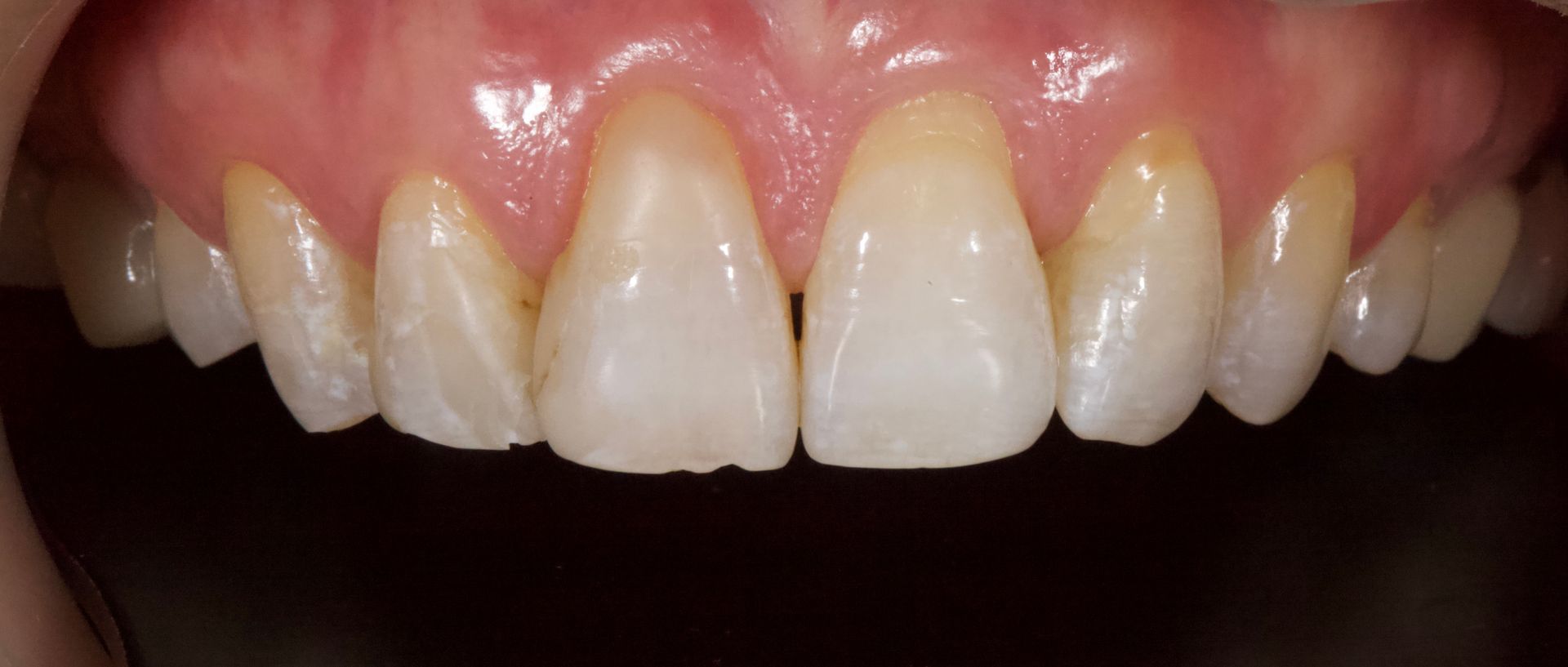 Close-up of upper front teeth with yellow staining near the gums and slightly uneven alignment
