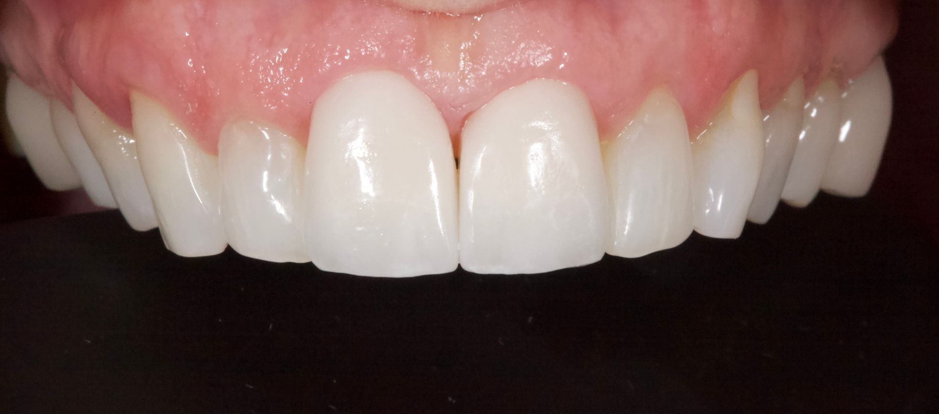 Close-up of upper front teeth with bright white dental veneers and pink gums