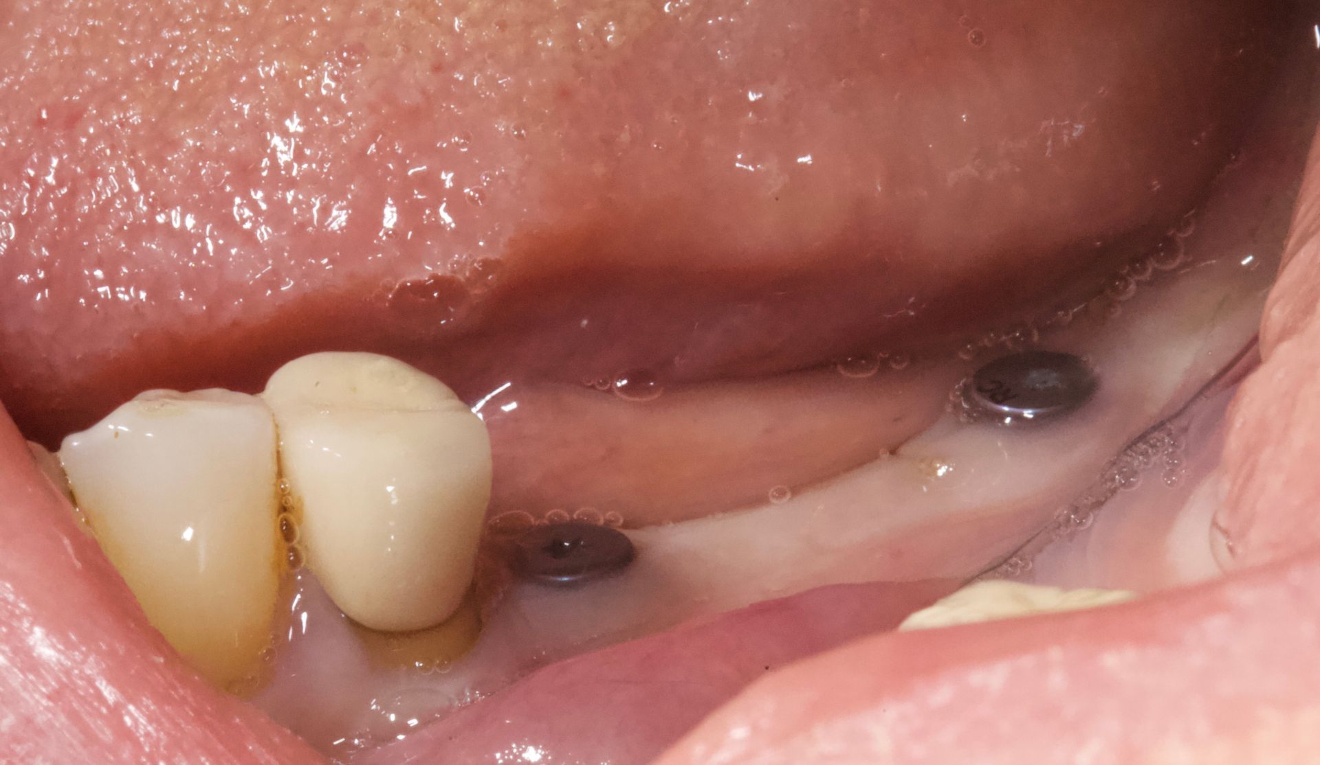 Close-up of lower gums and molars with two dark dental spots on the inner cheek side.