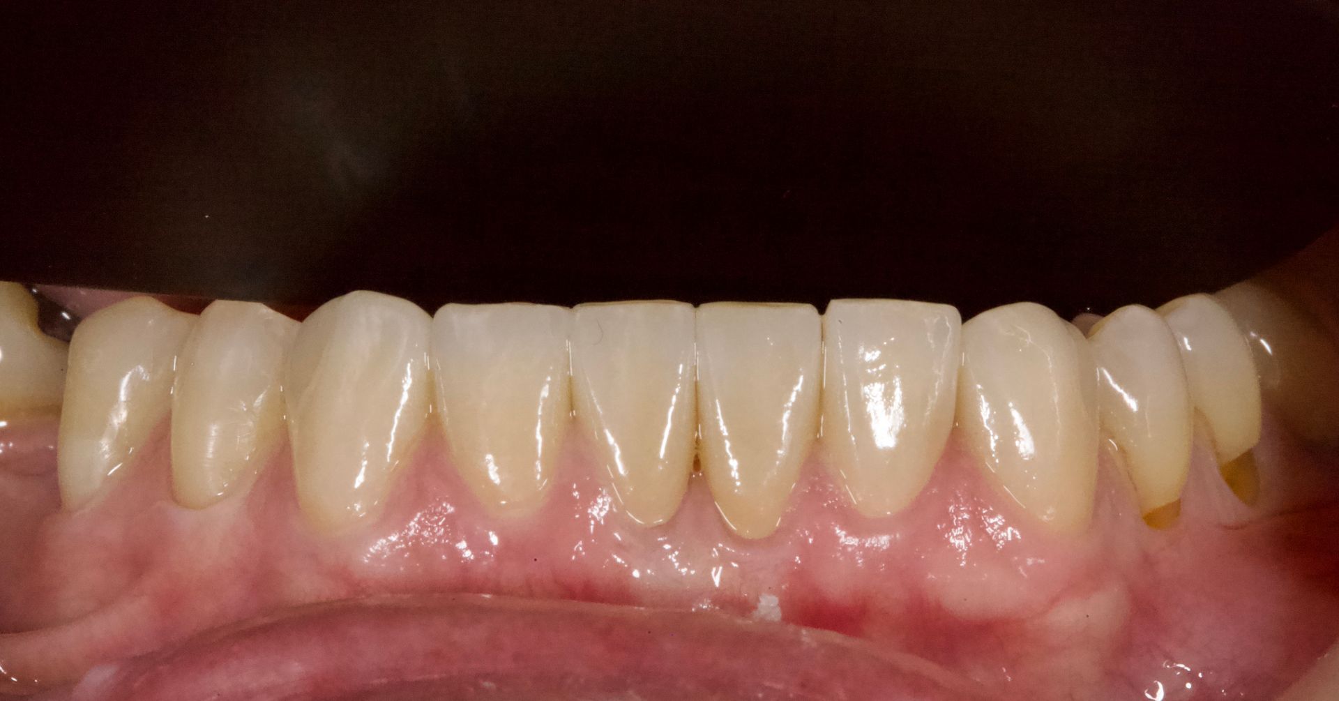 Close-up of lower front teeth and gums with pink irritation along the gumline