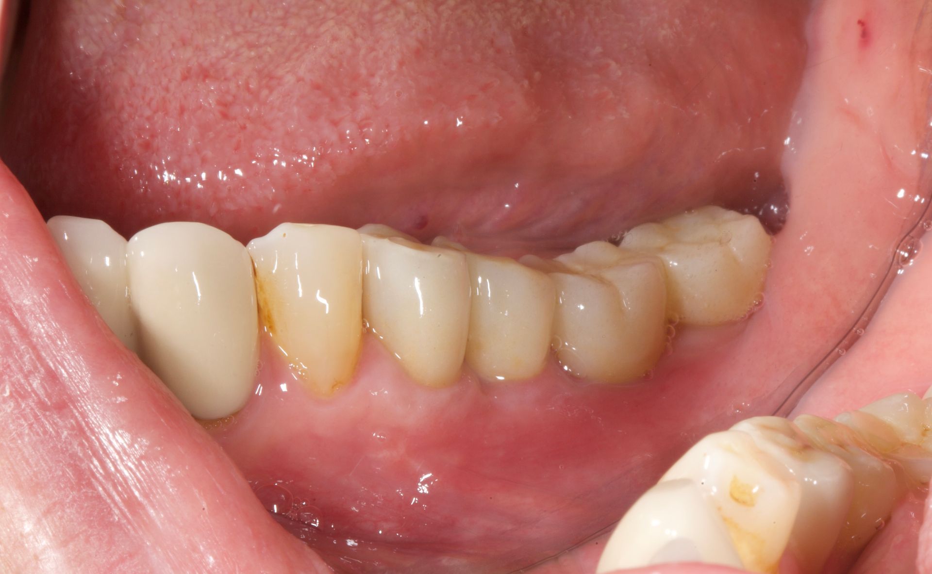 Close-up of lower teeth and gums with yellow plaque buildup and a finger holding the lip open