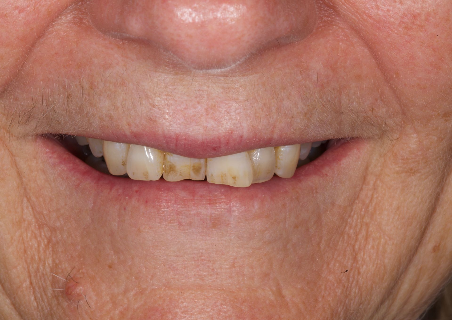 Close-up of a smiling mouth with uneven, yellowed front teeth