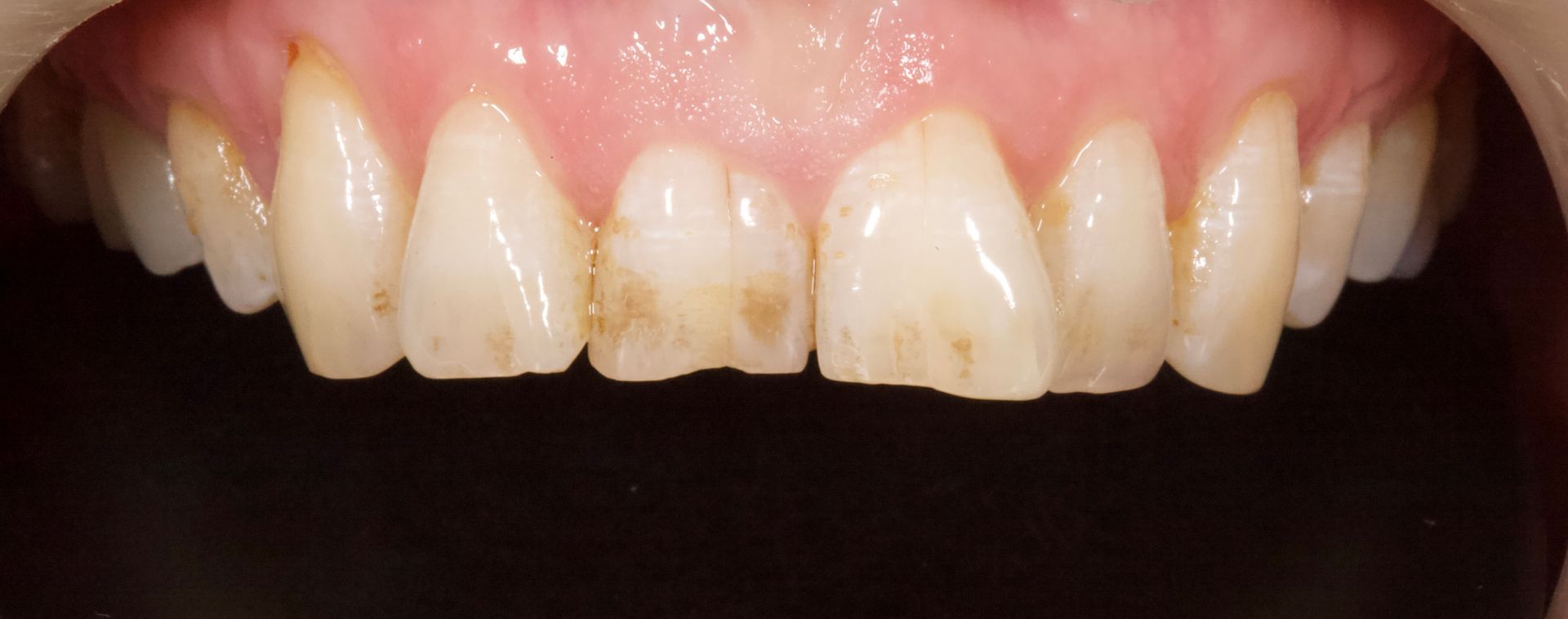 Close-up of upper front teeth with visible yellow discoloration and stains