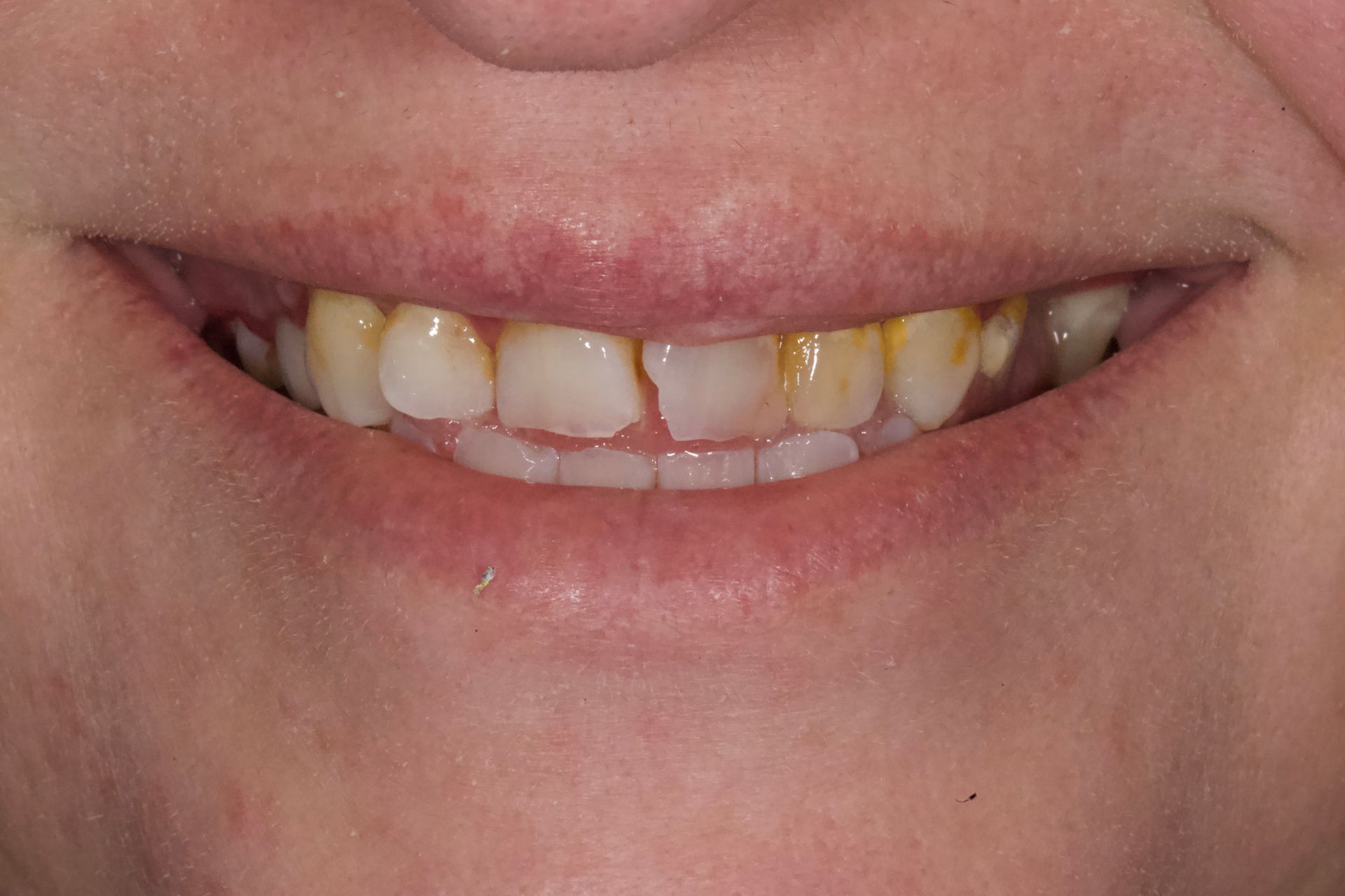 Close-up of a smiling mouth showing yellowed, stained teeth and slight gum exposure