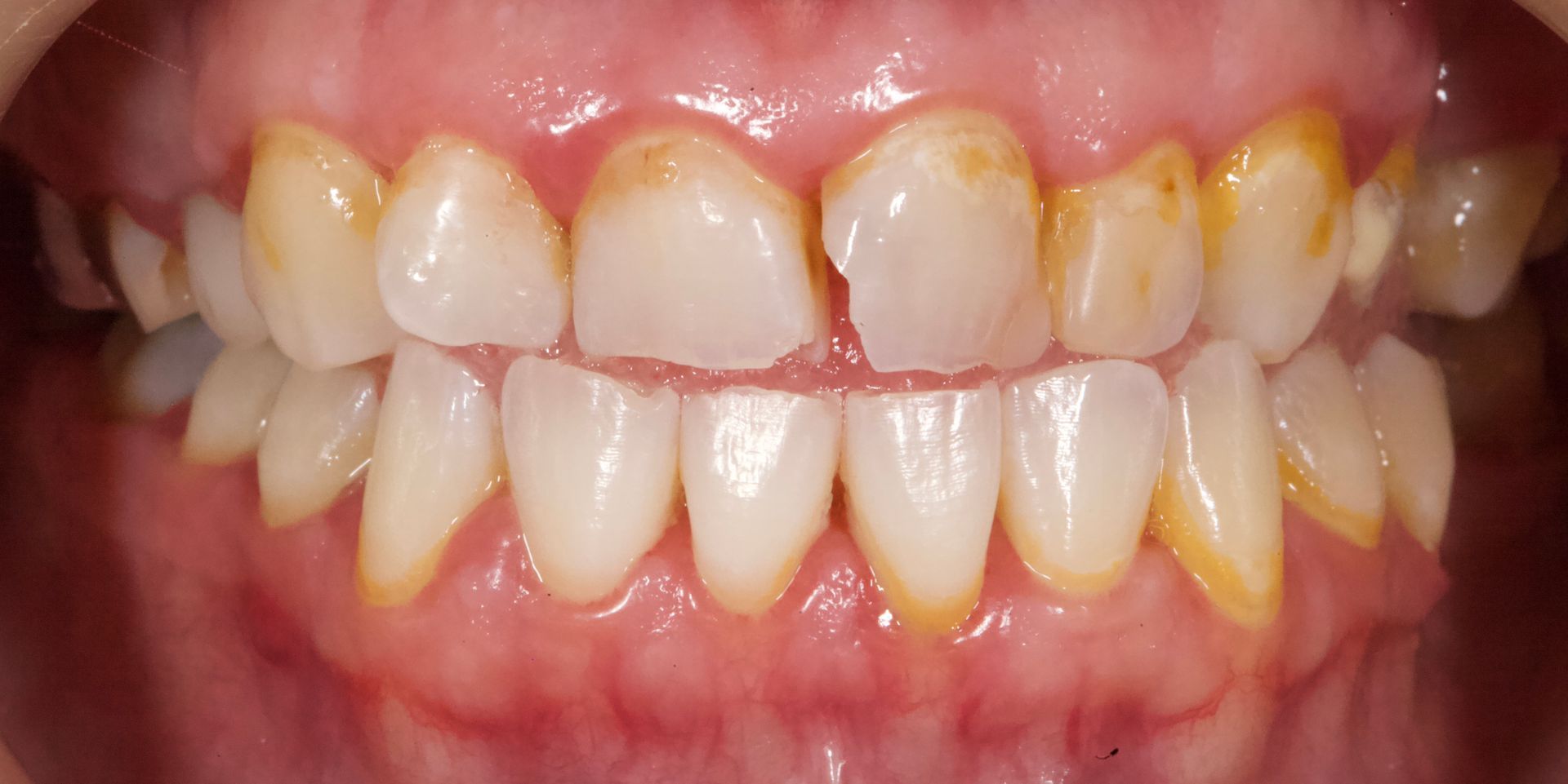 Close-up of teeth with yellow staining and crowded alignment, mouth slightly open