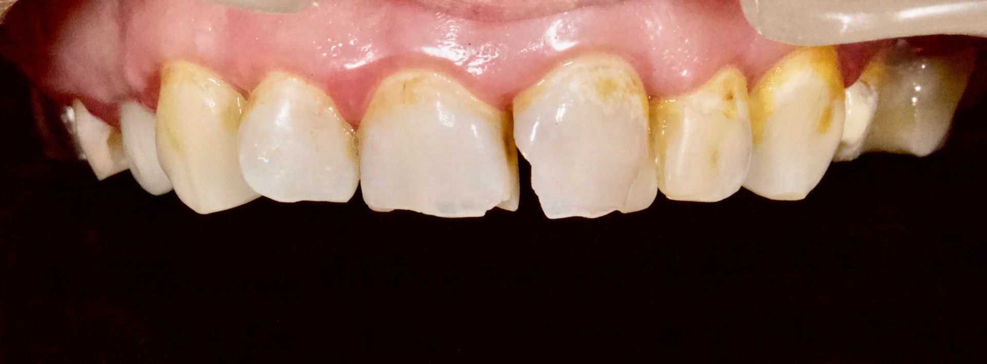Close-up of stained front teeth and gums against a dark background