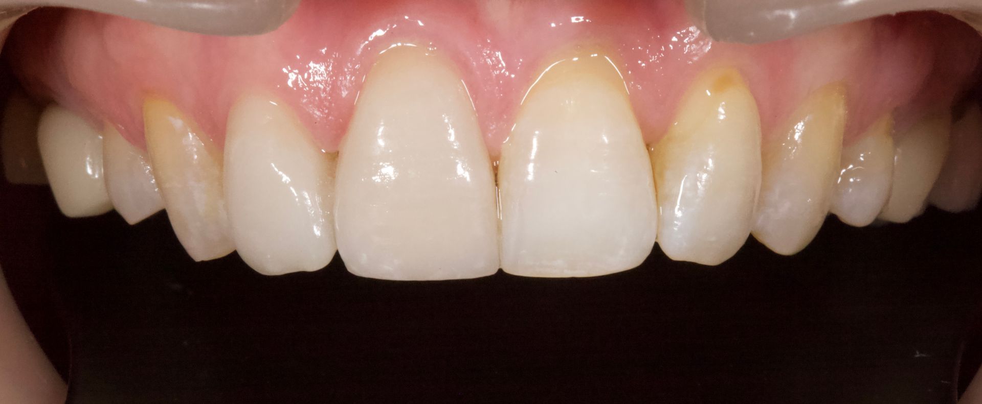 Close-up of upper front teeth and gums with a pink mouth interior