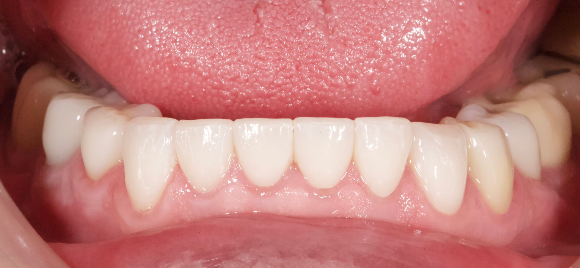 Close-up of white front teeth and gums with pink lips framing the mouth