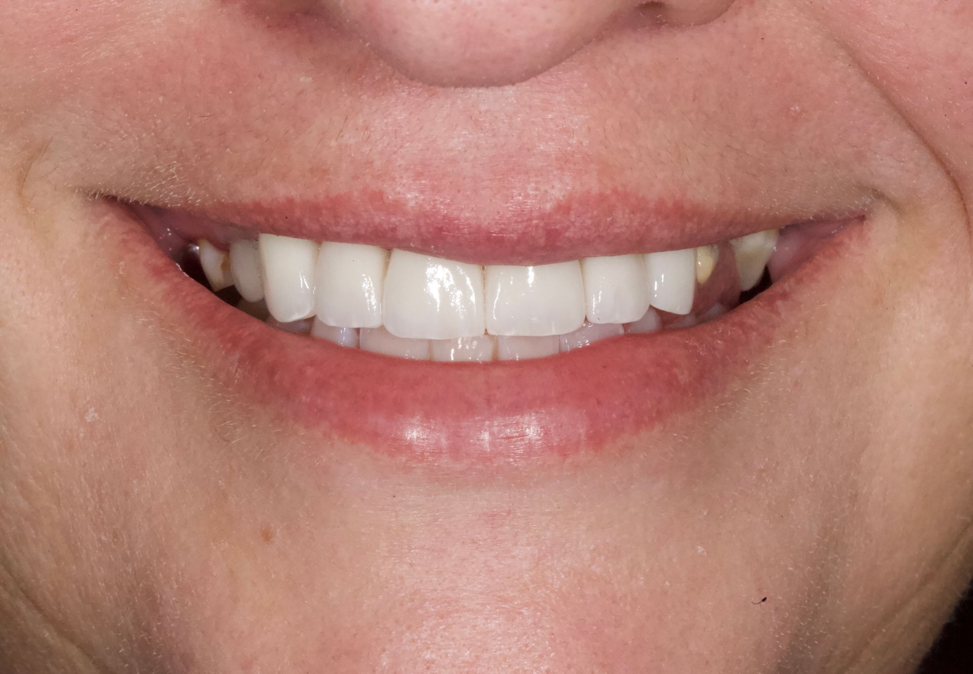 Close-up of a smiling mouth with white teeth and pink lips