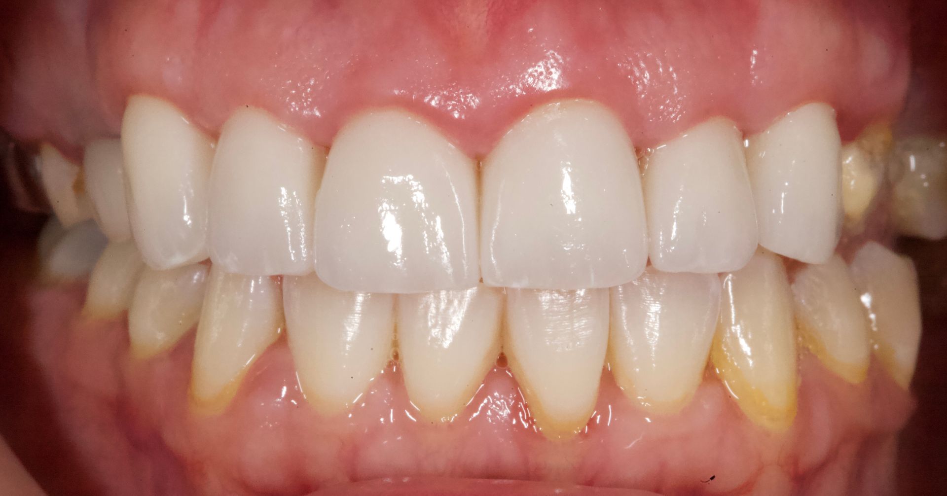Close-up of teeth and gums with yellow staining on the lower teeth