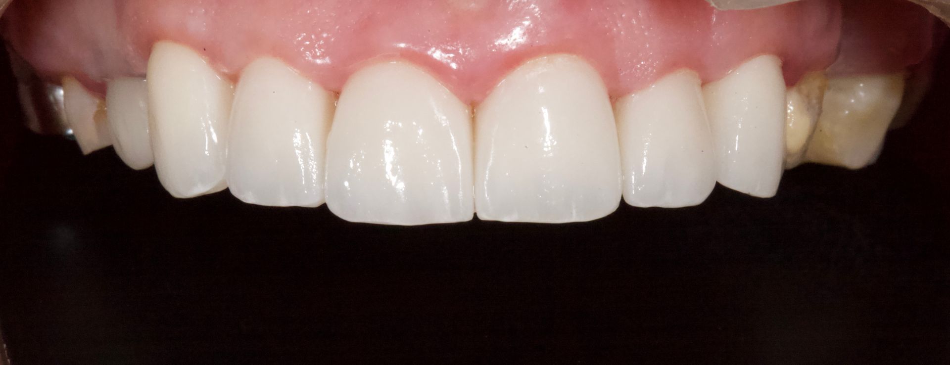 Close-up of a smiling mouth showing white teeth and pink gums