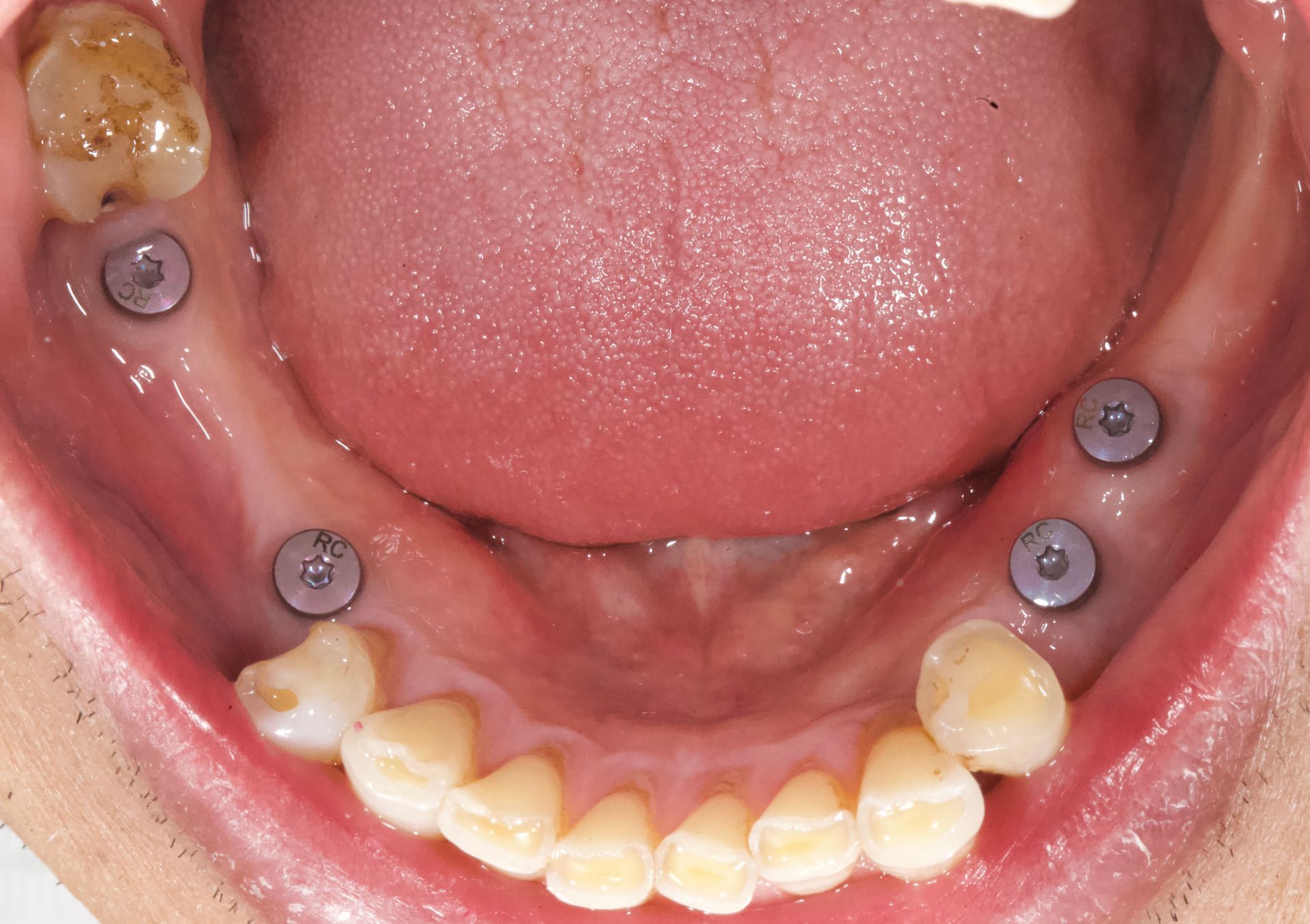 Open mouth showing lower teeth with several gray orthodontic attachments and a small gum lesion on the left side