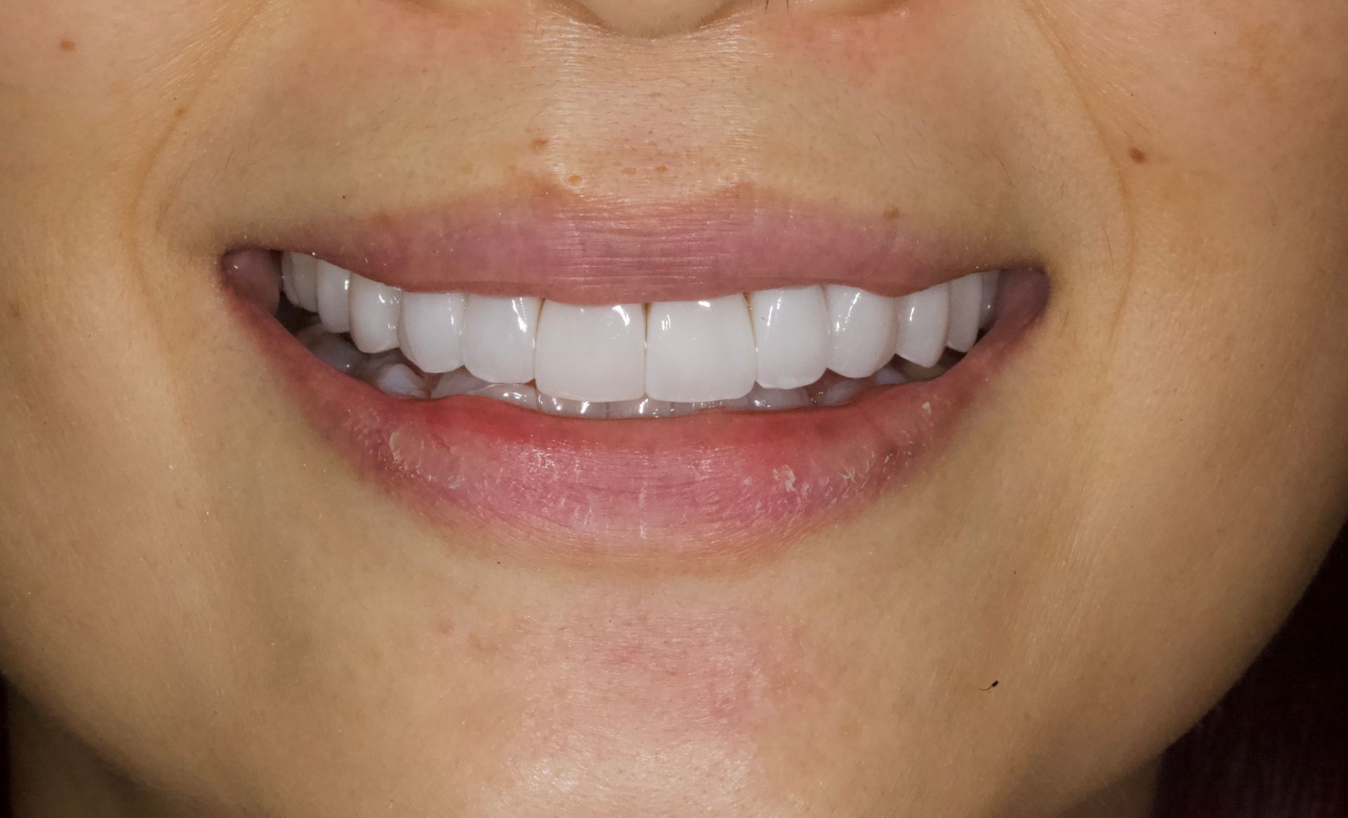 Close-up of a smiling mouth with straight white teeth and pink lips.
