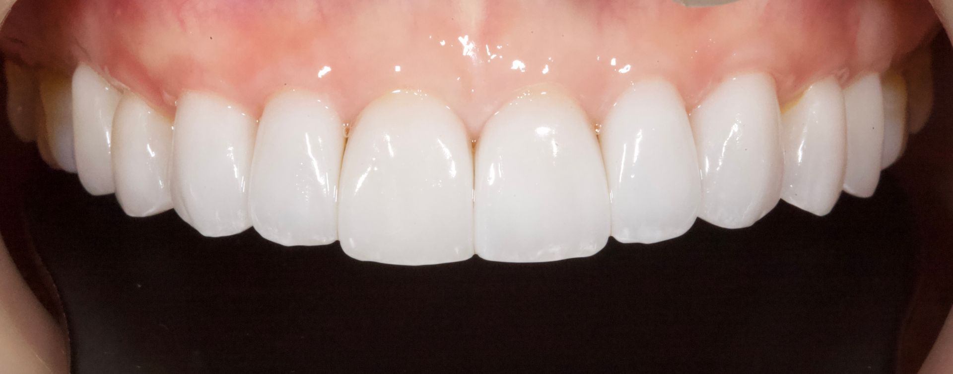 Close-up of a smiling mouth with bright white teeth and pink gums