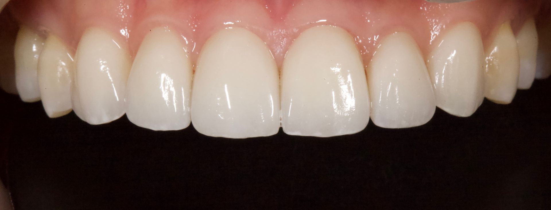 Close-up of white upper front teeth in a smile against a dark background