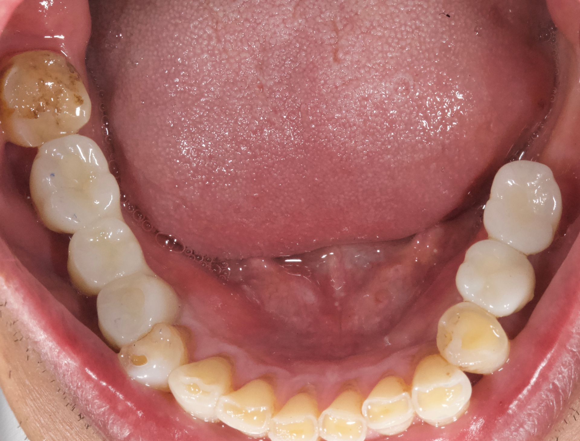 Open mouth showing lower teeth and tongue, with some yellow-brown staining on molars and front teeth.