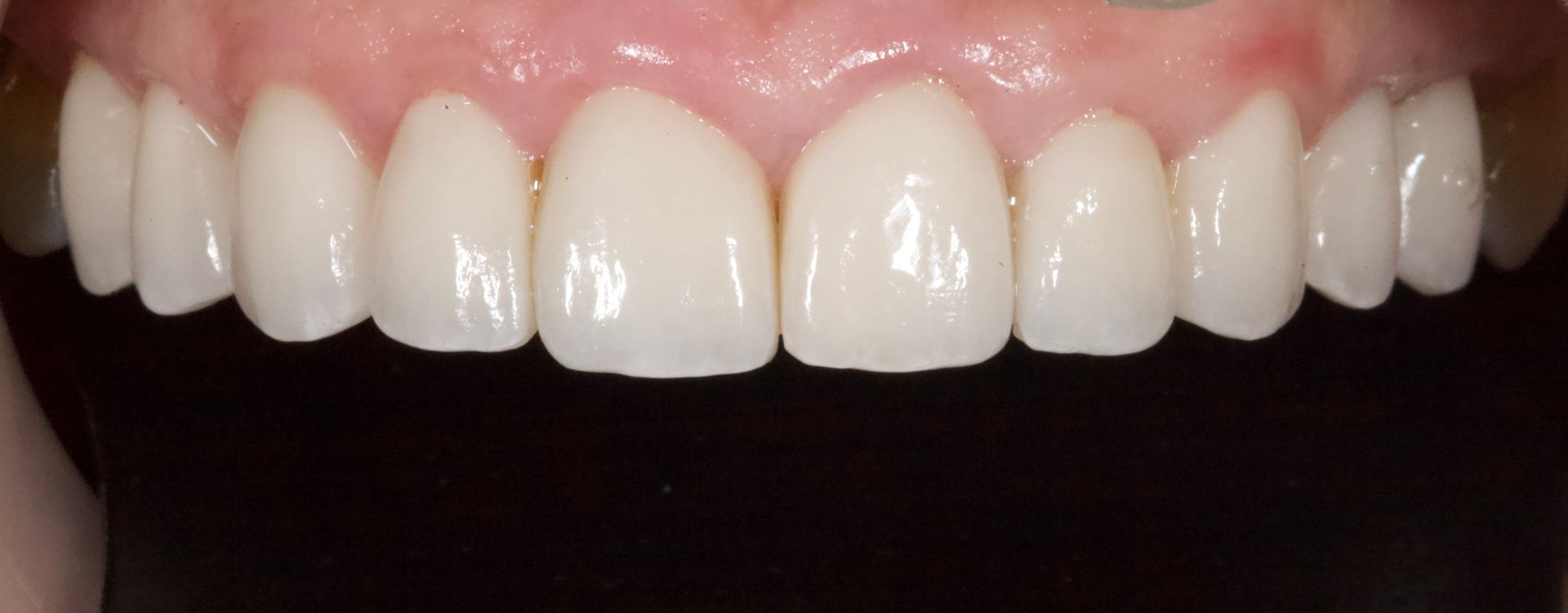 Close-up of a smiling mouth showing straight white teeth and pink gums