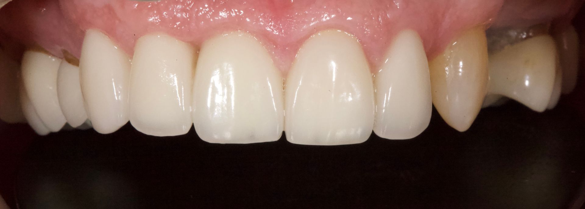 Close-up of teeth and gums, showing a slightly discolored upper right tooth