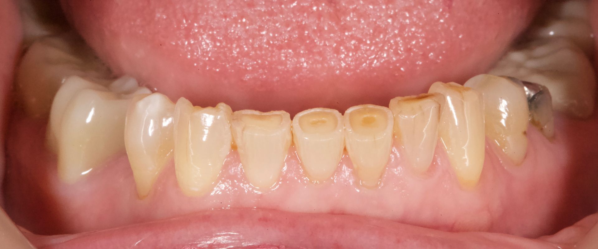 Close-up of lower front teeth with visible yellowing and wear under the tongue