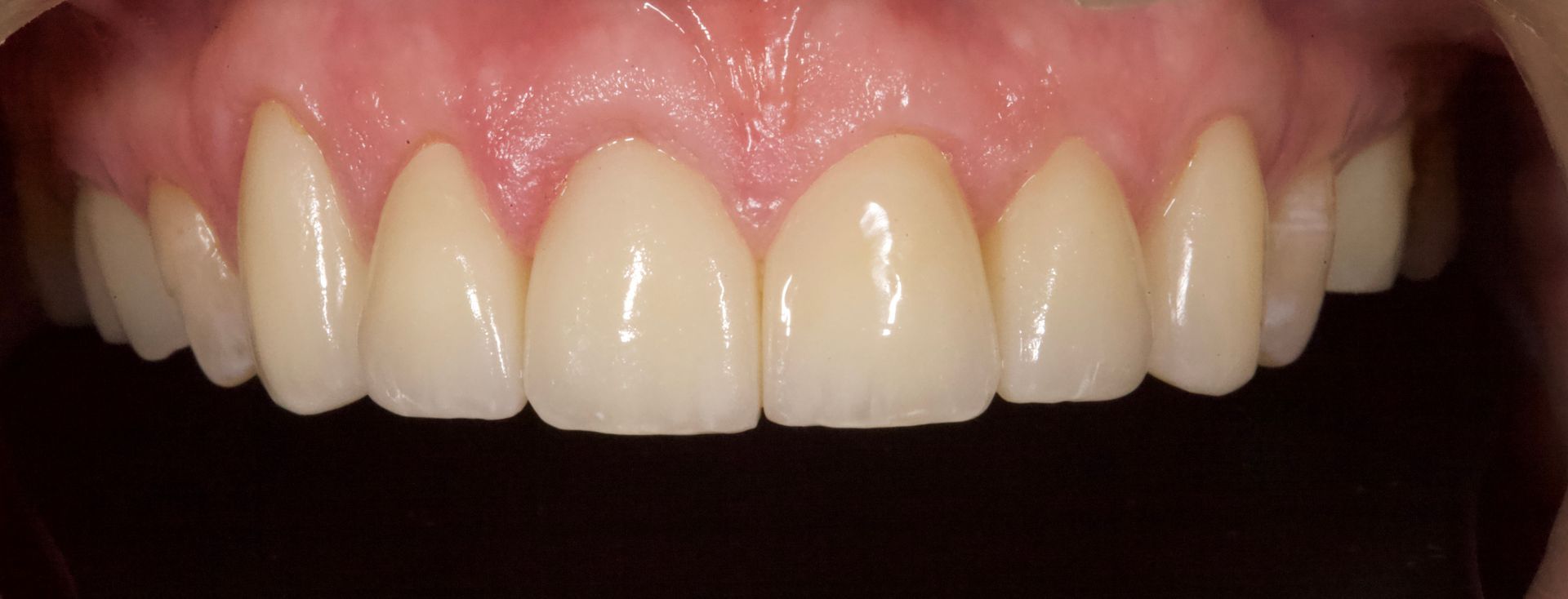Close-up of a smiling mouth with straight white teeth and pink gums