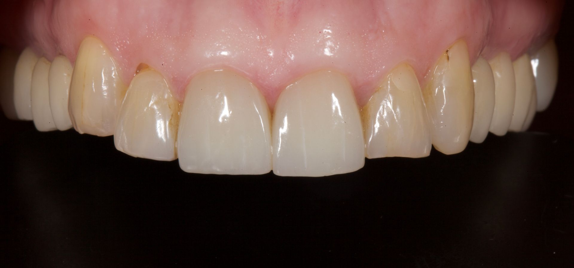 Close-up of front teeth with slight yellowing and pink gums on a black background