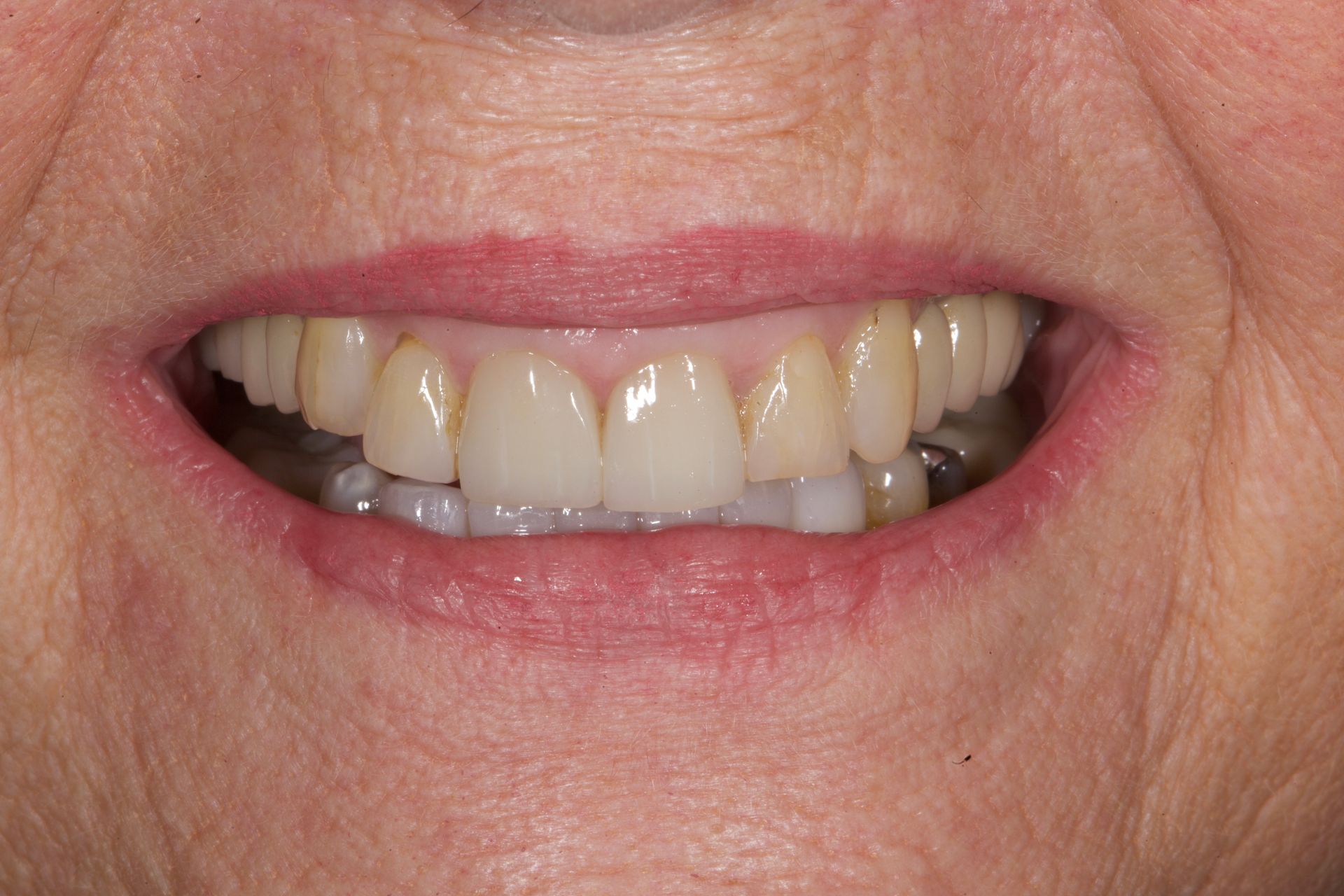 Close-up of a smiling mouth with uneven front teeth and visible discoloration