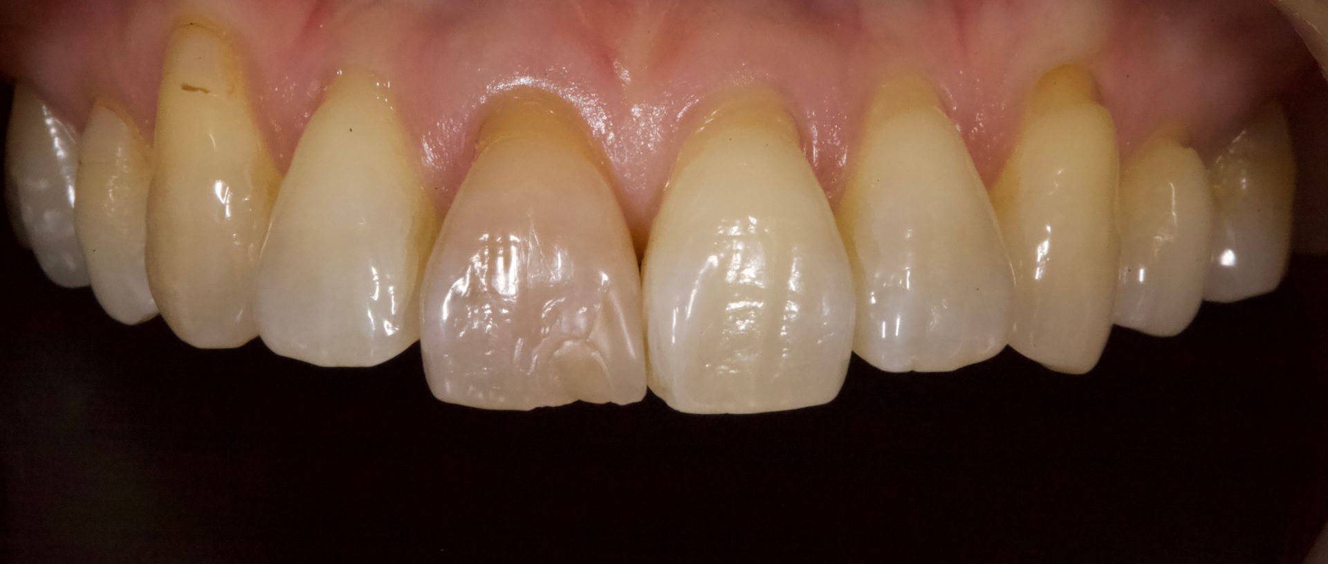 Close-up of upper front teeth with yellowing and slight discoloration on the enamel
