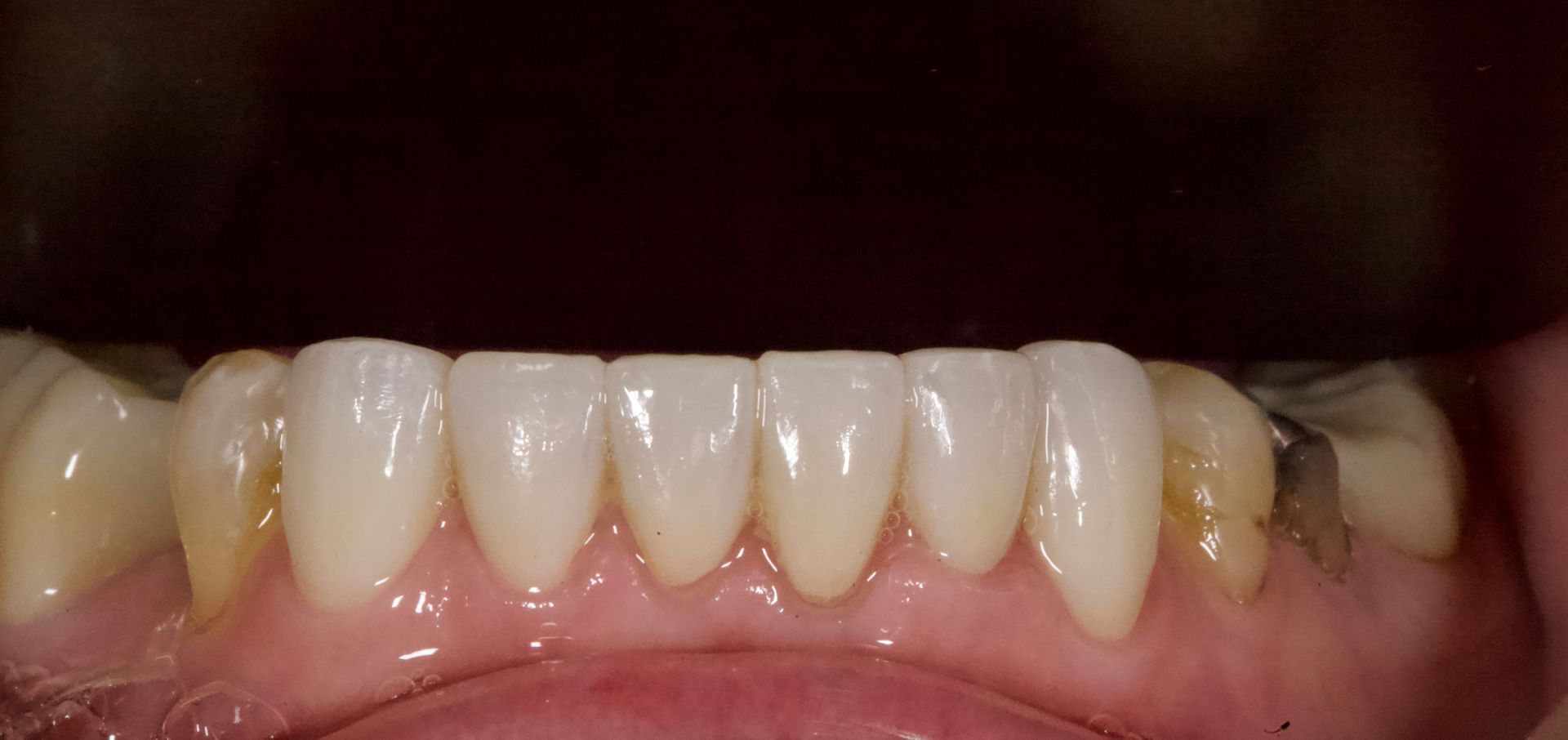 Close-up of teeth and gums with slight discoloration near the back teeth