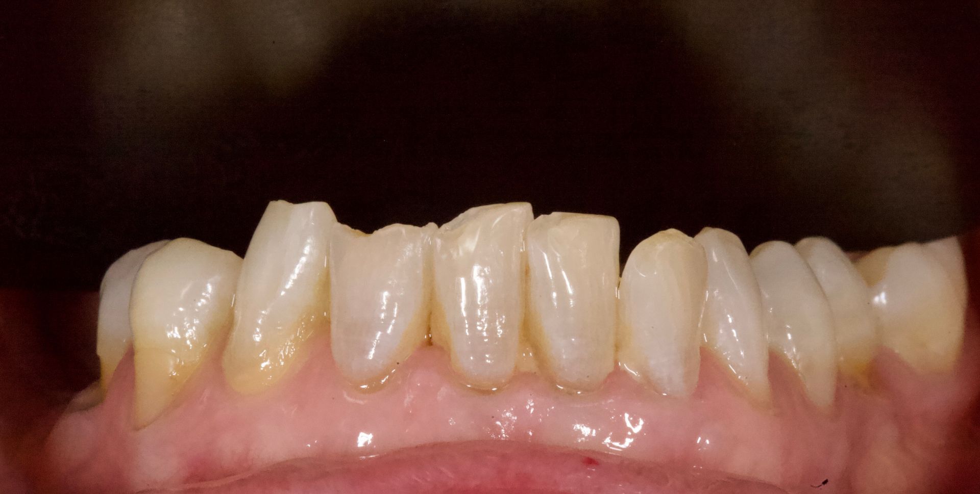 Close-up of human teeth and gums with slight yellowing and crowding