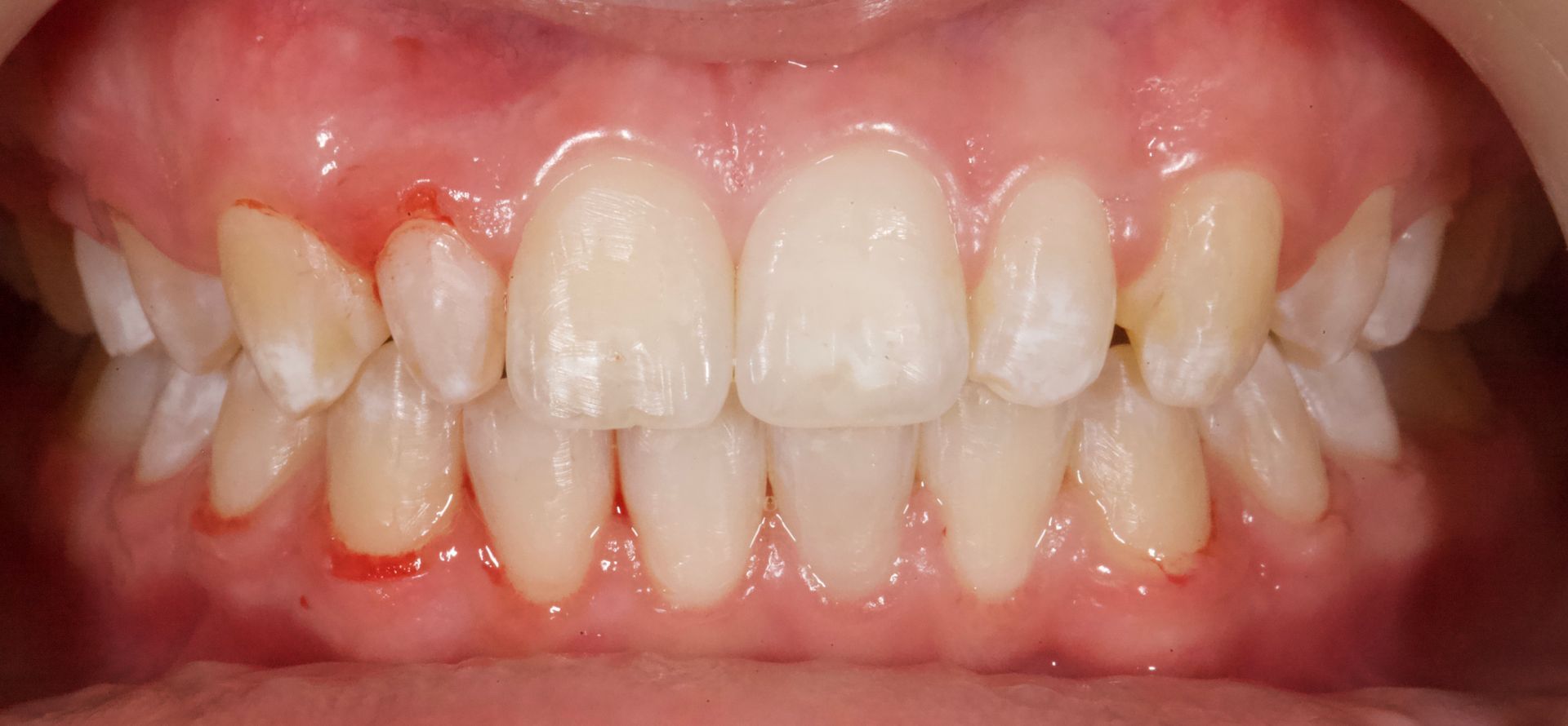 Front view of teeth with a red, inflamed upper gum line and slight crowding