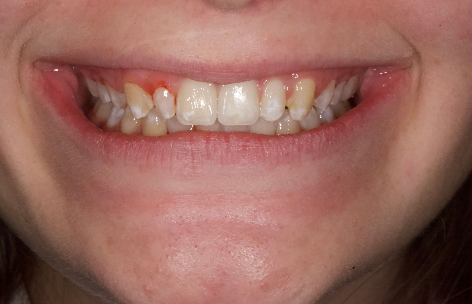 Close-up of a smiling mouth with slightly crooked front teeth and braces on the left side