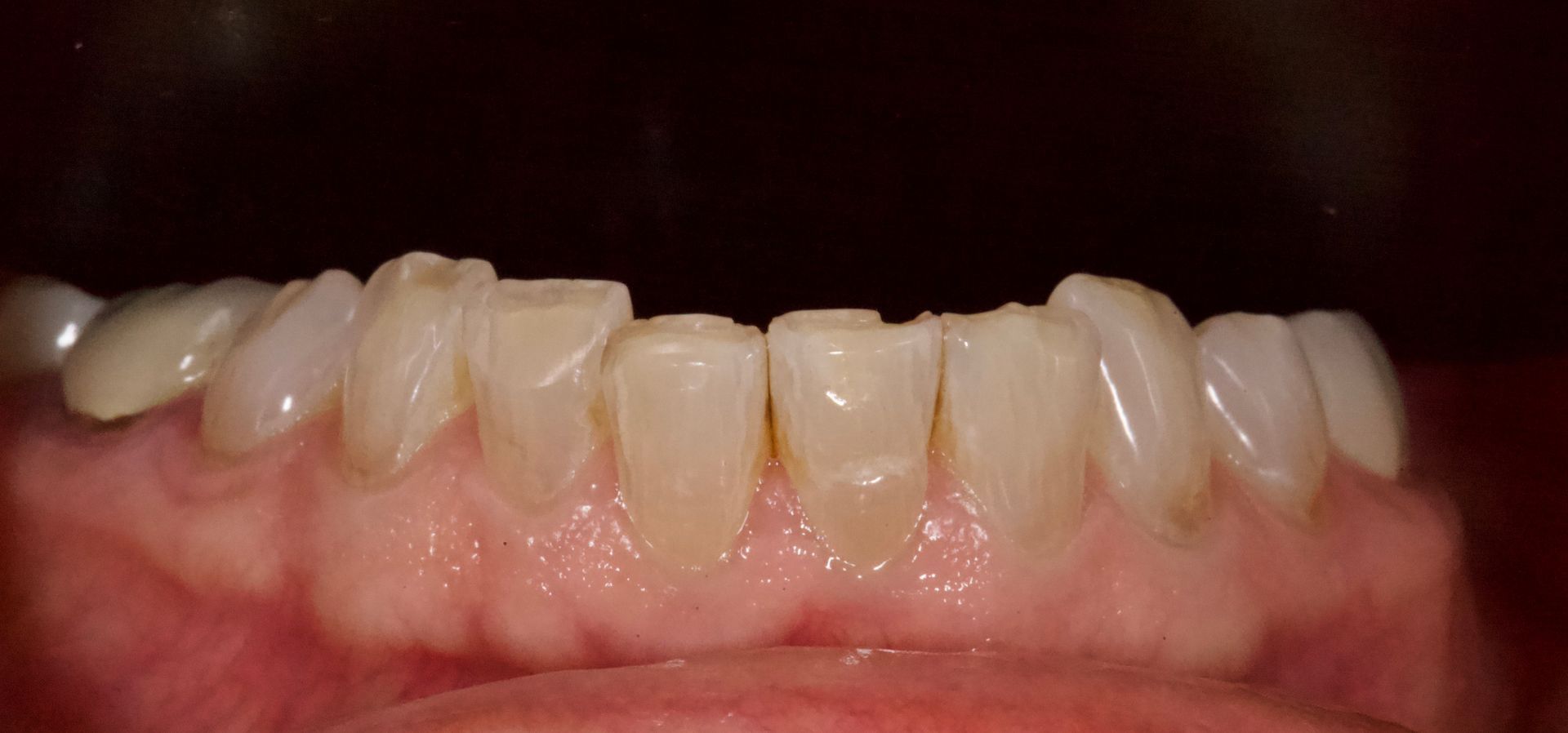 Close-up of front teeth with visible crowding and misalignment, with lips slightly parted.