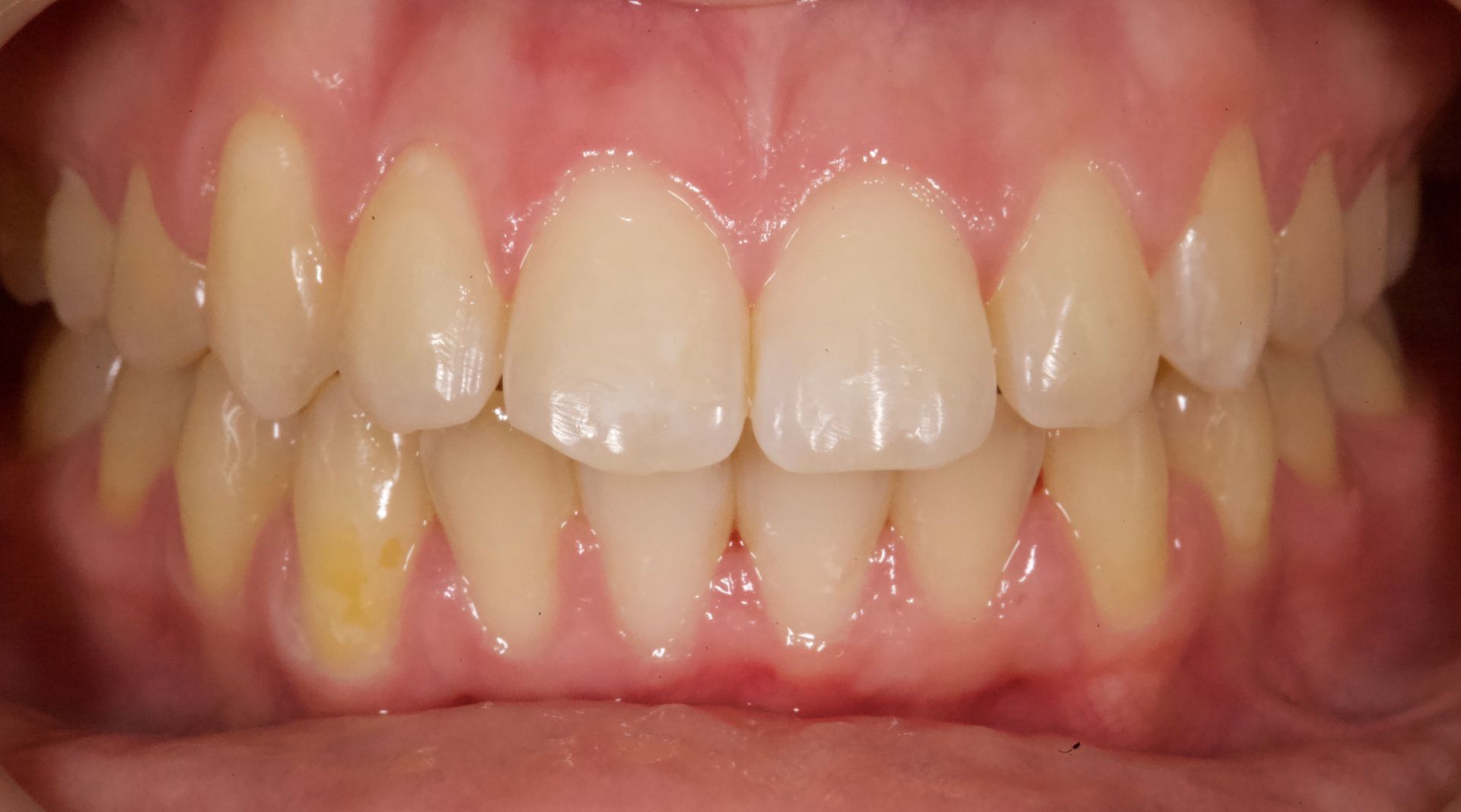 Close-up of teeth and gums with yellow plaque buildup along the lower front teeth