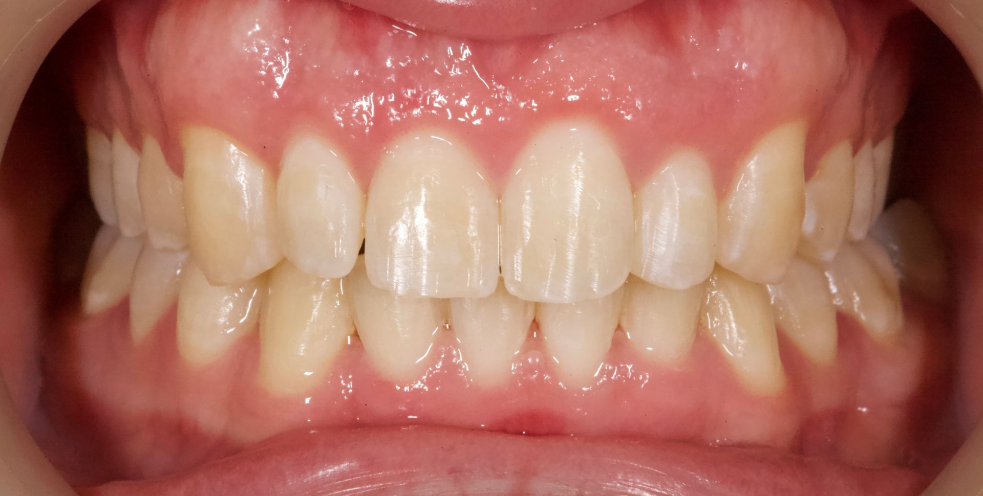 Close-up of a person’s teeth and gums with a slight gap between the front teeth.