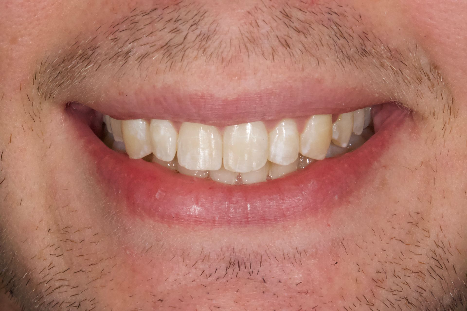 Close-up of a smiling mouth with visible teeth and light facial stubble