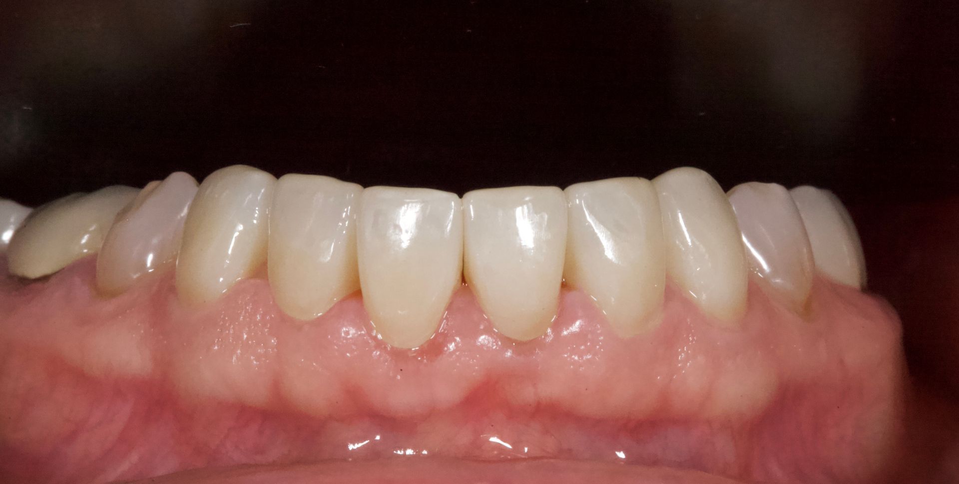 Close-up of upper and lower teeth with pink gums against a dark background