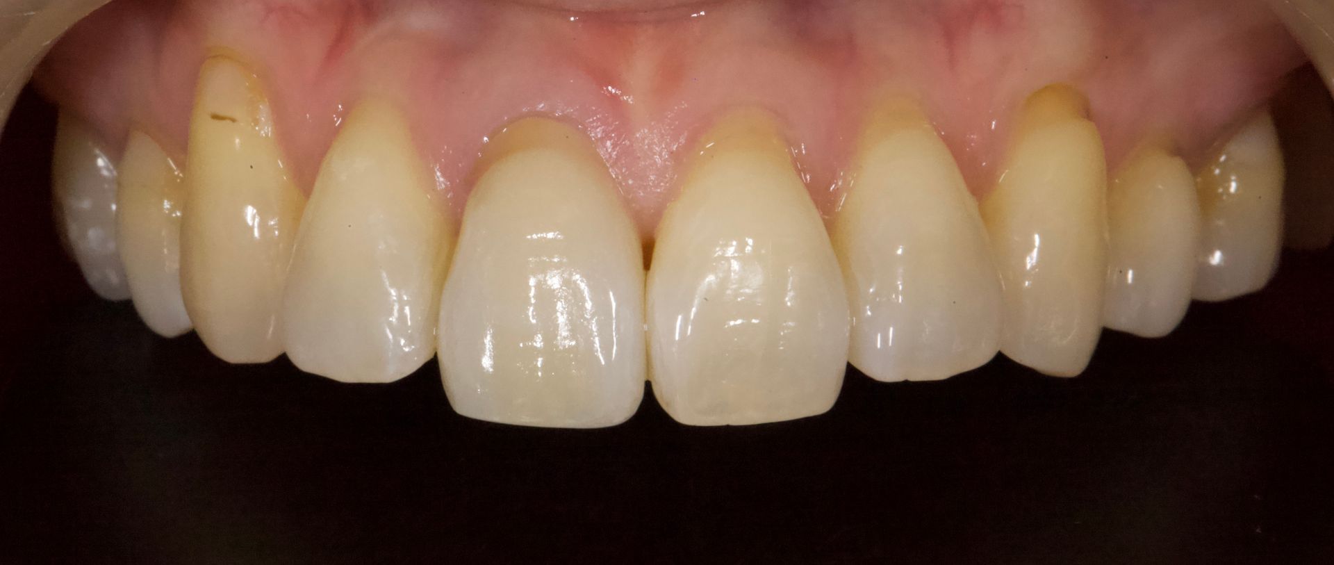 Close-up of upper front teeth with a slight yellow tint and pink gums