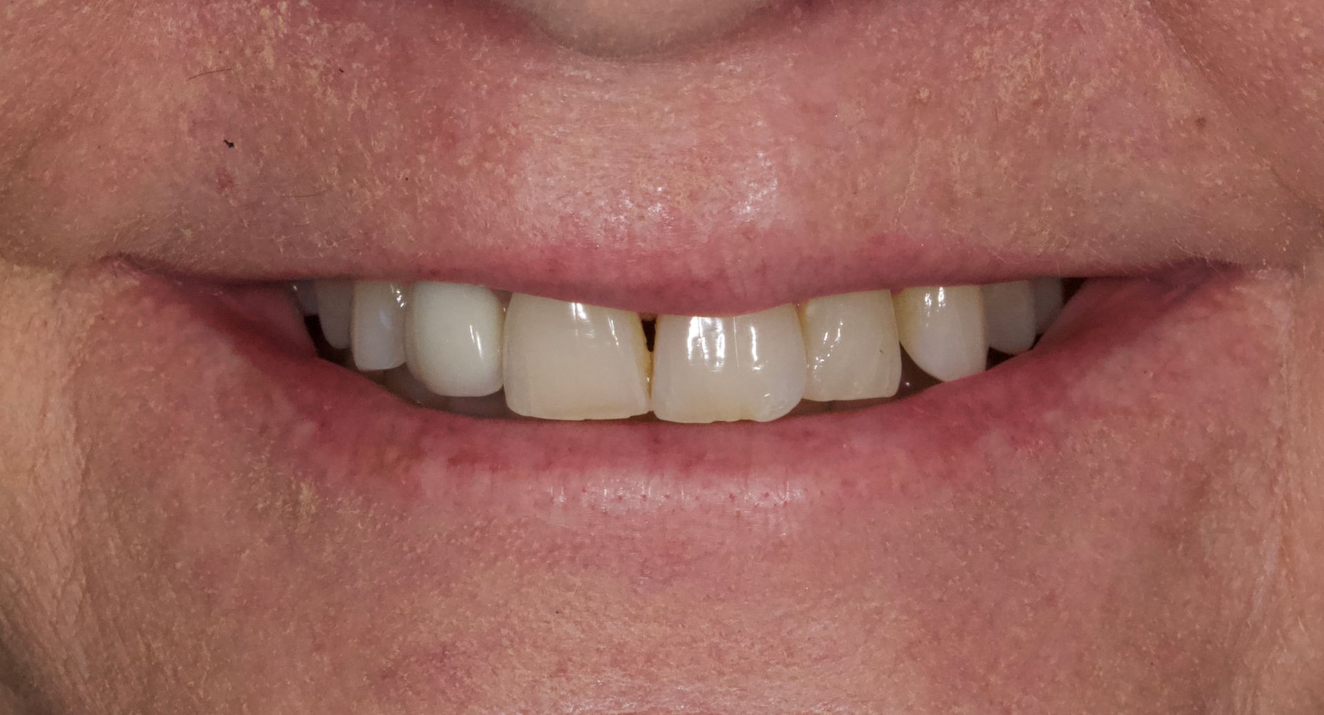 Close-up of a smiling mouth with visible teeth and pink lips