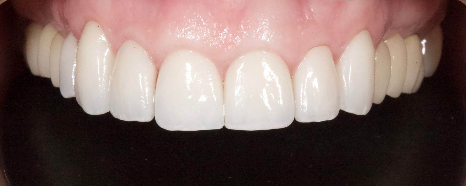Close-up of a smiling mouth with white teeth and pink gums