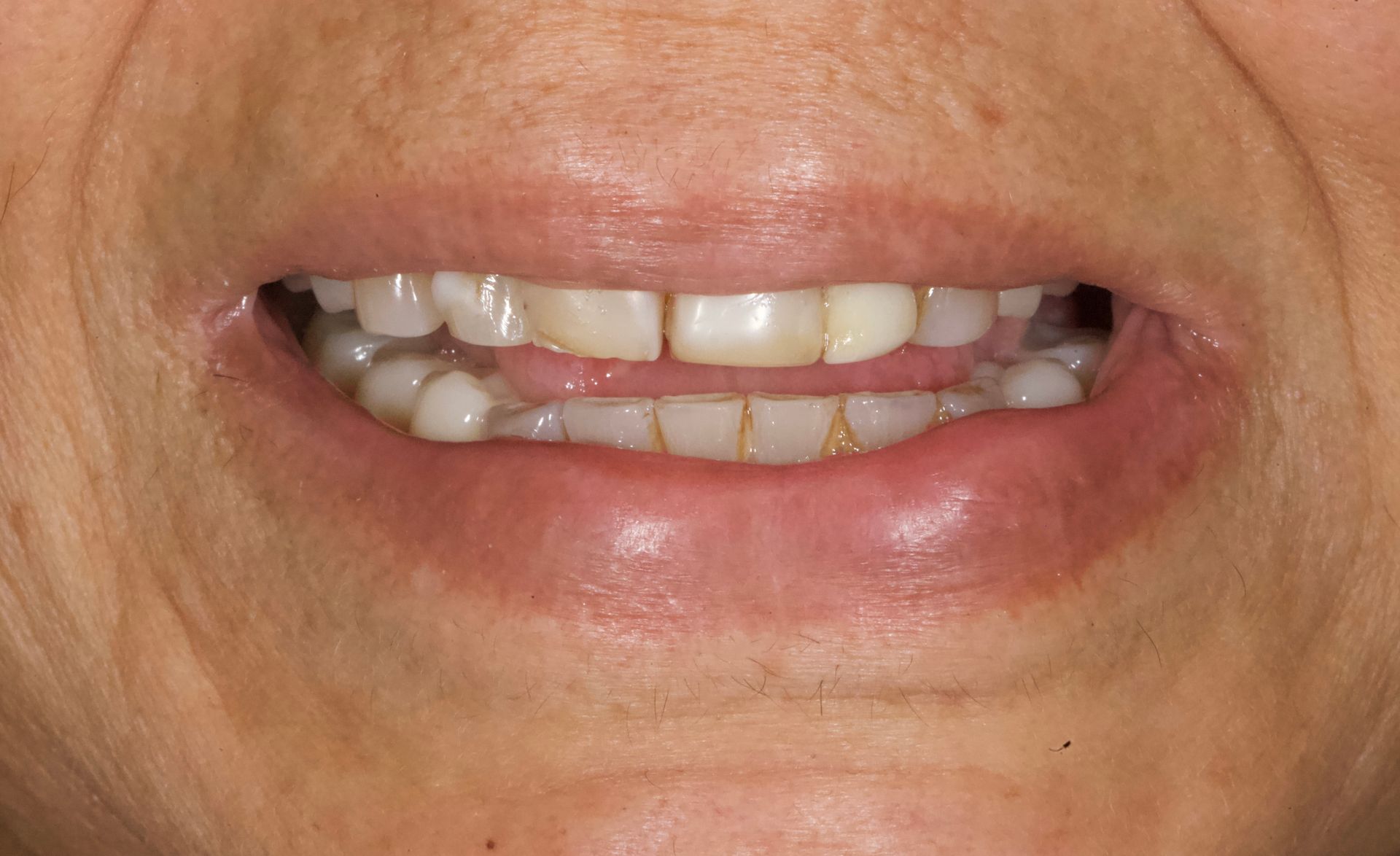 Close-up of a mouth showing teeth with silver braces and a slight smile