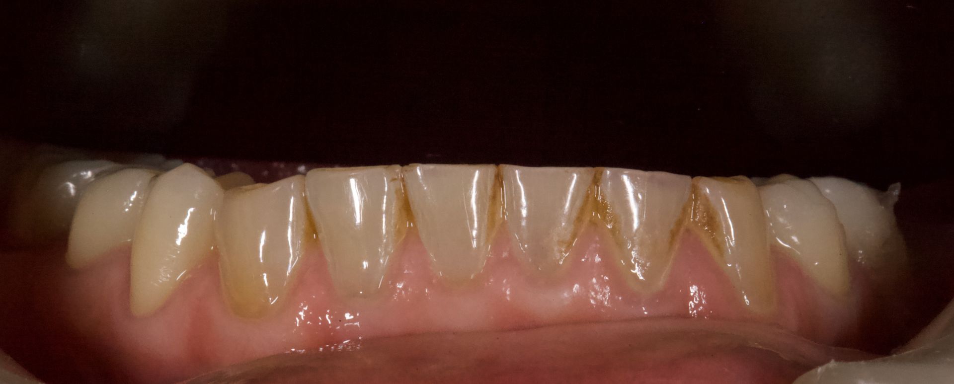 Close-up of upper teeth and gums with white dental aligners in a mouth