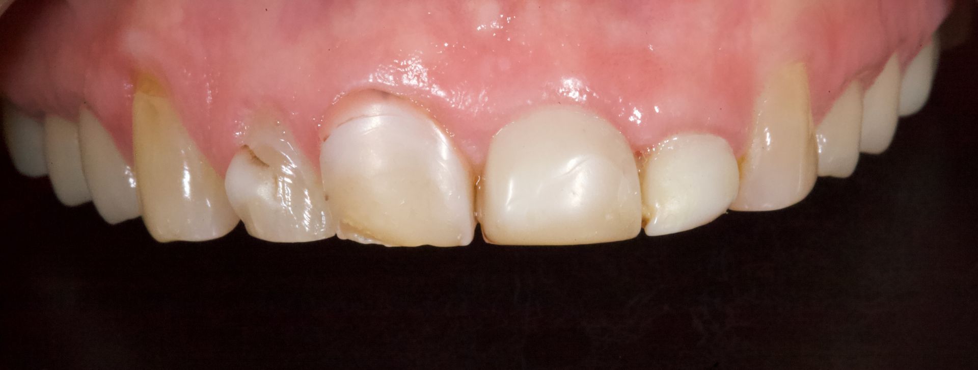 Close-up of a smiling mouth showing upper front teeth and pink gums