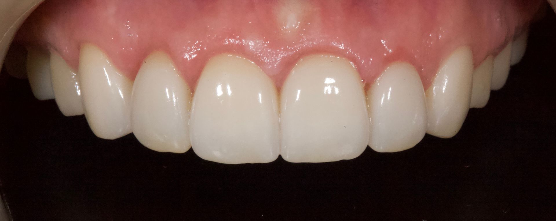 Close-up of a smiling mouth with white teeth and pink gums