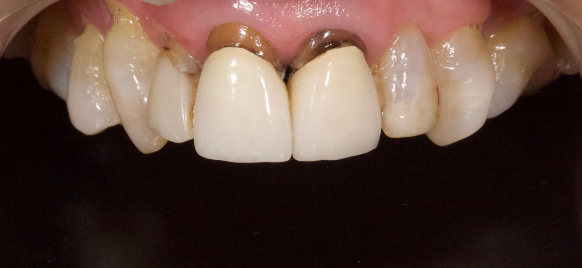 Close-up of front upper teeth with a single bright white central tooth against pink gums.