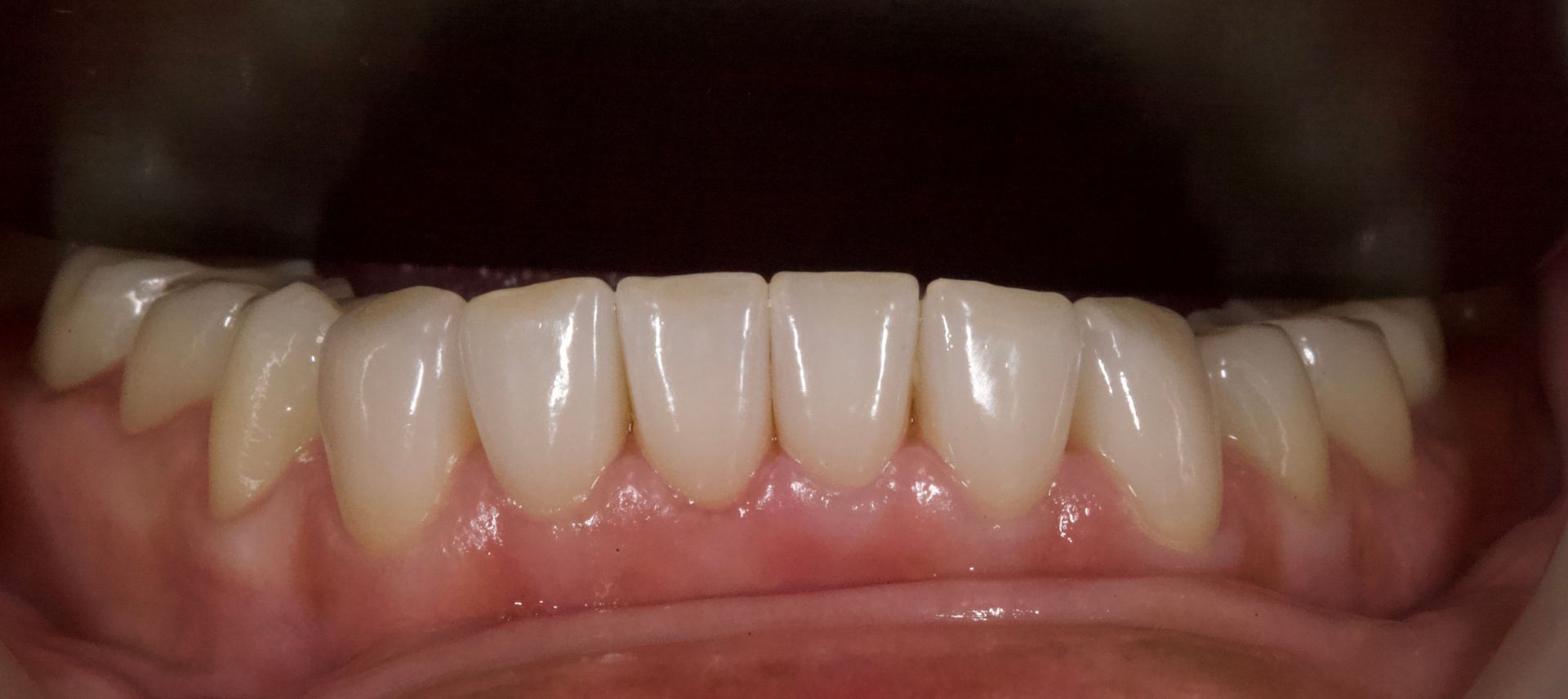 Close-up of a human mouth showing white teeth in a slight smile